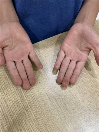 9歲小學(xué)生長(zhǎng)期拍煙卡，手部粗糙長(zhǎng)繭。受訪者供圖